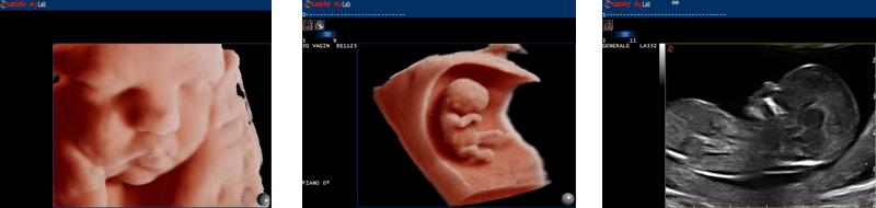 Schwangerschaftsultraschall_ESAOTE